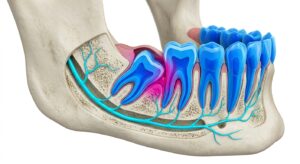 매복사랑니의 해부학적 구조와 인접 치아 관계를 보여주는 3D 의학 일러스트